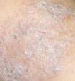 example of eczema flare-up