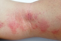 example of eczema flare-up