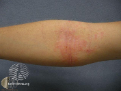 example of eczema flare-up