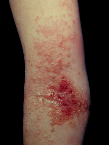 infected eczema