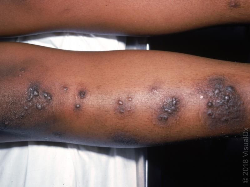 infected eczema